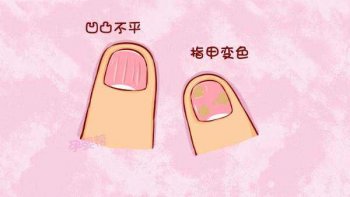 得了灰指甲应该怎么护理