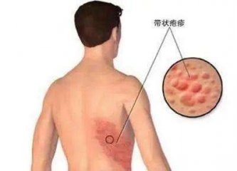 带状疱疹是怎么引起