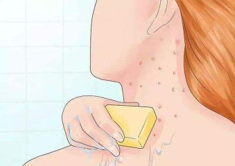 如何防止毛囊炎的出现