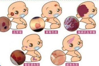 毛细血管瘤的临床表现
