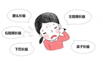 如何科学去除粉刺痘痘
